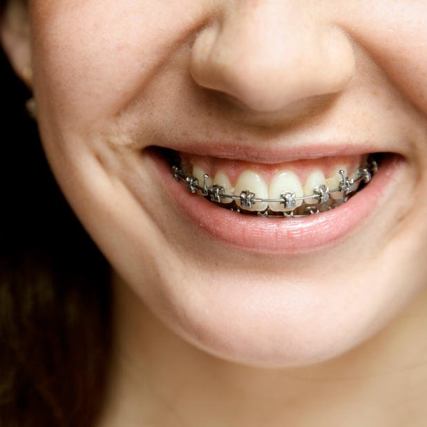 Cheap Family Braces From As Low As 2999 Orthodontics Calgary