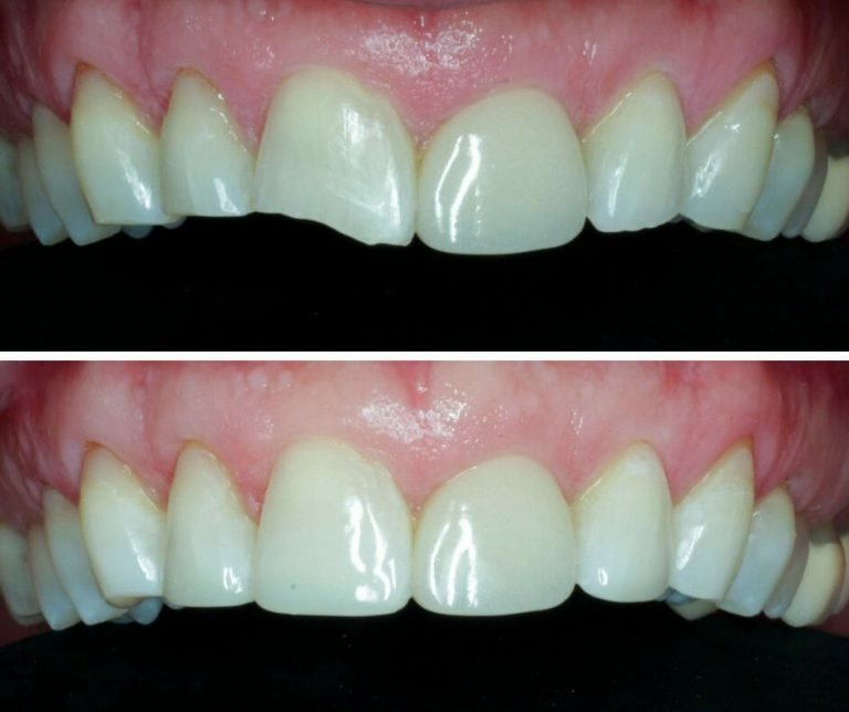 Cosmetic Fillings Before and After