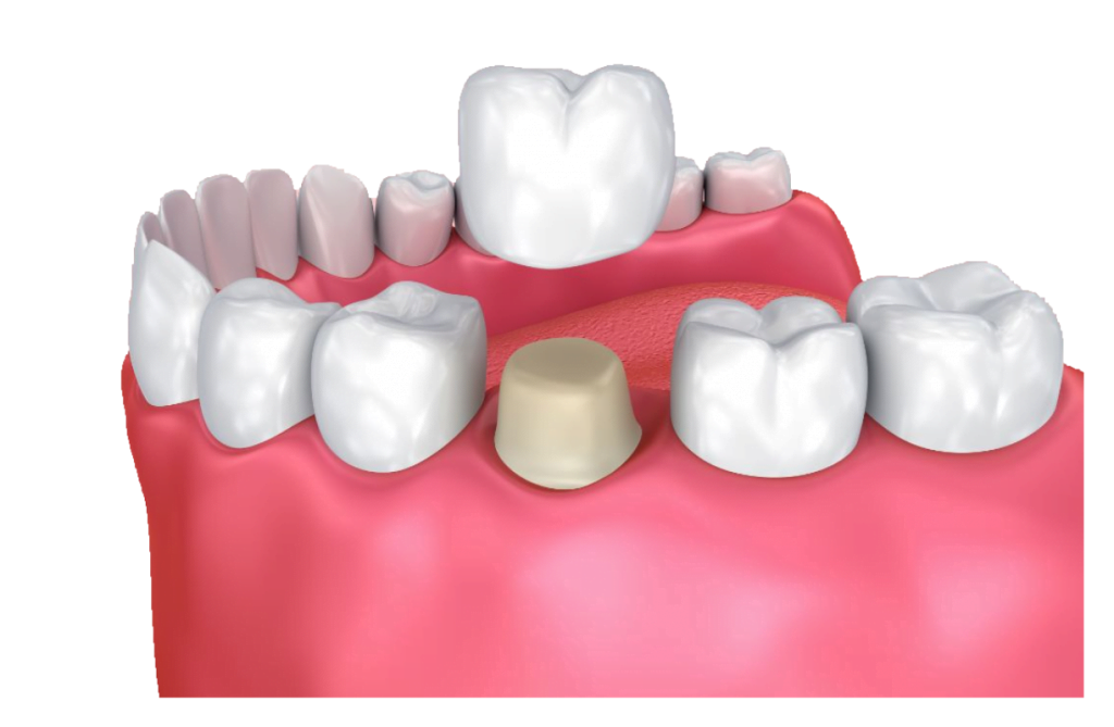 3D Rendering Crowns at Dental Now Panorama